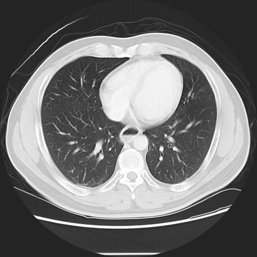 Achalasia (Radiopaedia 8831-9629 Axial lung window 41).jpg