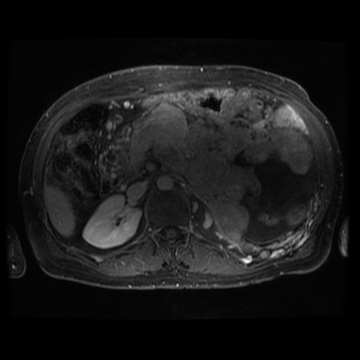 Acinar cell carcinoma of the pancreas (Radiopaedia 75442-86668 Axial T1 C+ fat sat 55).jpg
