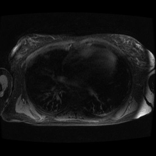 Acinar cell carcinoma of the pancreas (Radiopaedia 75442-86668 Axial late phase (~30 mins) 152).jpg