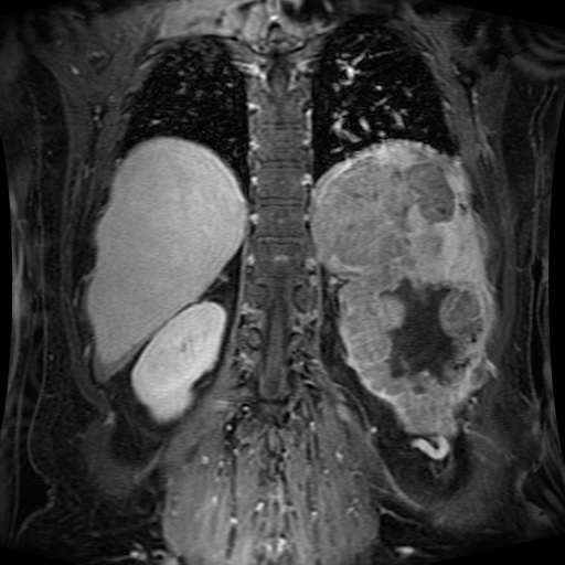 Acinar cell carcinoma of the pancreas (Radiopaedia 75442-86668 Coronal T1 C+ fat sat 53).jpg