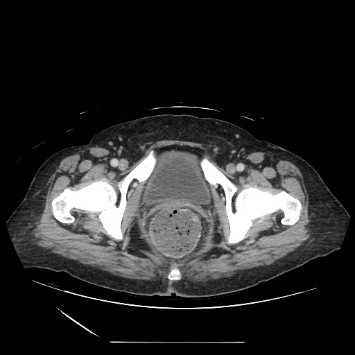 Acinar cell carcinoma of the pancreas (Radiopaedia 75442-86669 Axial C+ portal venous phase 143).jpg