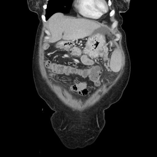 File:Acinar cell carcinoma of the pancreas (Radiopaedia 75442-86669 Coronal C+ portal venous phase 26).jpg