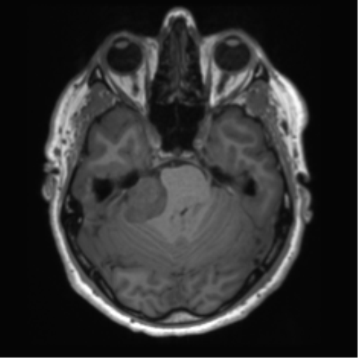 File:Acoustic schwannoma (Radiopaedia 50846-56358 Axial T1 30).png
