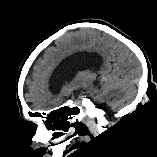 File:Acoustic schwannoma (Radiopaedia 55729-62280 Sagittal non-contrast 14).png