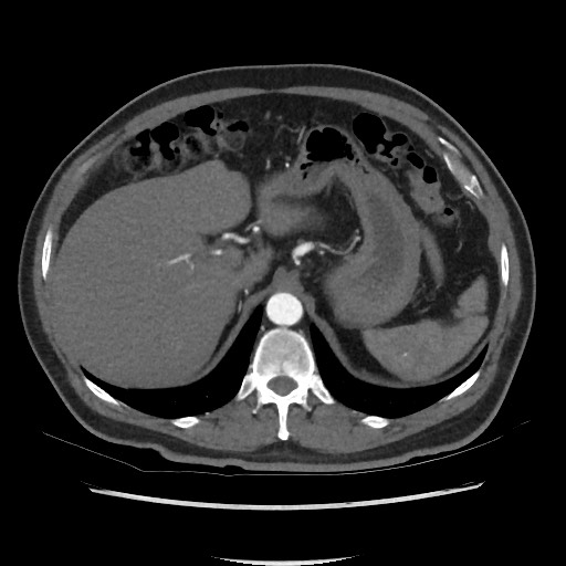 File:Active colonic bleed on CT (Radiopaedia 49765-55025 Axial C+ arterial phase 20).jpg