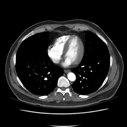 File:Active colonic bleed on CT (Radiopaedia 49765-55025 Axial C+ arterial phase 3).jpg