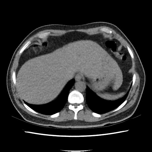 Active colonic bleed on CT (Radiopaedia 49765-55025 Axial non-contrast 10).jpg