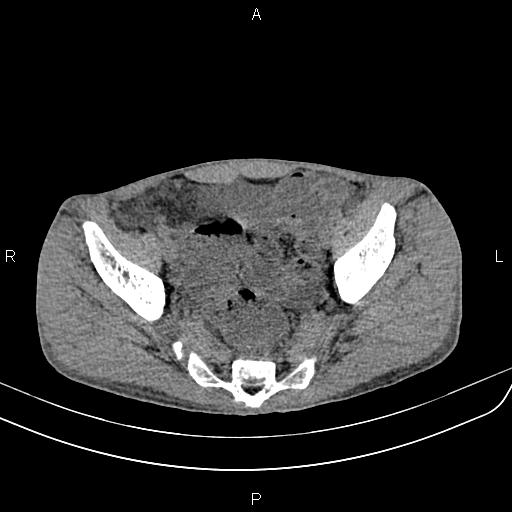 Active crohn disease (Radiopaedia 87133-103397 Axial non-contrast 86).jpg