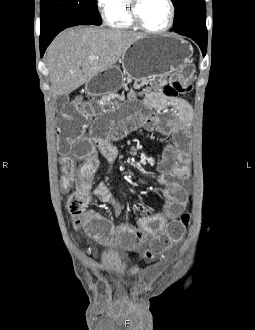 Active crohn disease (Radiopaedia 87133-103397 Coronal C+ arterial phase 14).jpg