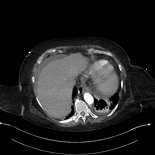 Active renal extravasation with large subcapsular and retroperitoneal hemorrhage (Radiopaedia 60975-68796 Axial C+ arterial phase 30).jpg