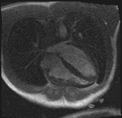 File:Active right ventricular cardiac sarcoidosis (Radiopaedia 55596-62100 Axial Dynamic perfusion scan MOCO 43).jpg