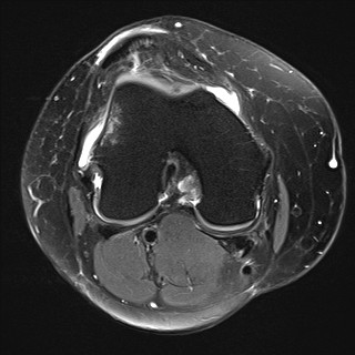 File:Acute-on-chronic transient lateral patellar dislocation with trochlear dysplasia (Radiopaedia 84099-99349 Axial PD fat sat 17).jpg