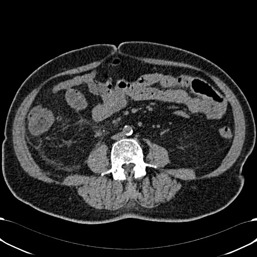 Acute appendicitis (Radiopaedia 58627-65818 Axial non-contrast 50).jpg