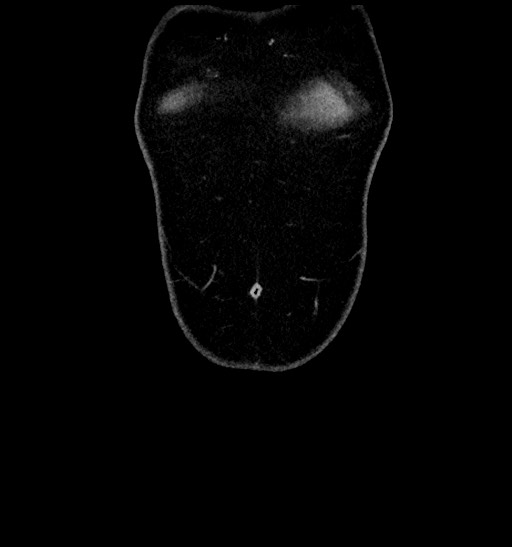 Acute appendicitis (Radiopaedia 77016-88960 Coronal C+ portal venous phase 13).jpg