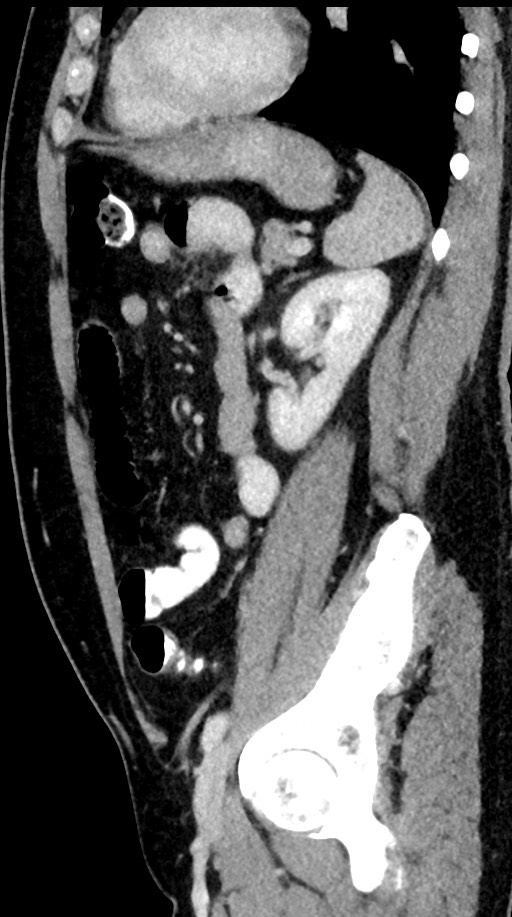 Acute appendicitis (Radiopaedia 77016-88960 Sagittal C+ portal venous phase 38).jpg