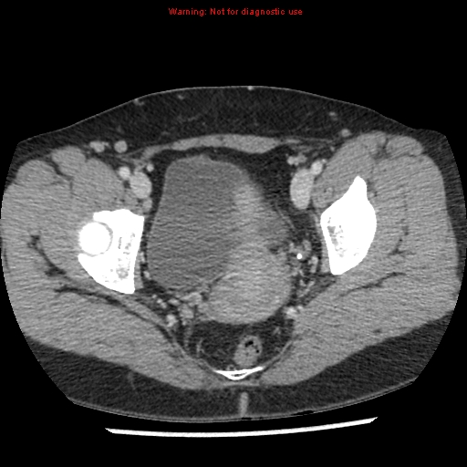 Acute appendicitis (Radiopaedia 7966-8812 C+ portal venous phase 50).jpg