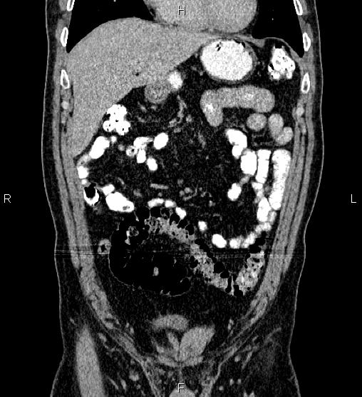 Acute appendicitis (Radiopaedia 84780-100240 Coronal C+ portal venous phase 23).jpg