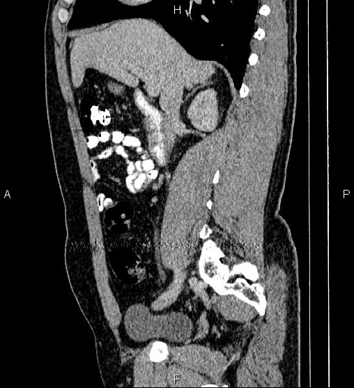 File:Acute appendicitis (Radiopaedia 84780-100240 Sagittal C+ portal venous phase 39).jpg