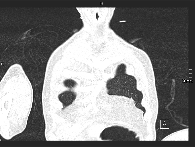 File:Acute aspiration pneumonitis (Radiopaedia 55642-62166 Coronal lung window 10).jpg