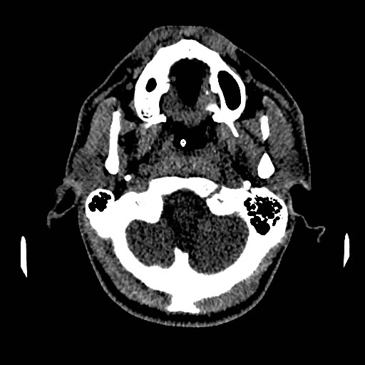 Acute basilar artery occlusion (Radiopaedia 43582-46985 Axial non-contrast 32).jpg