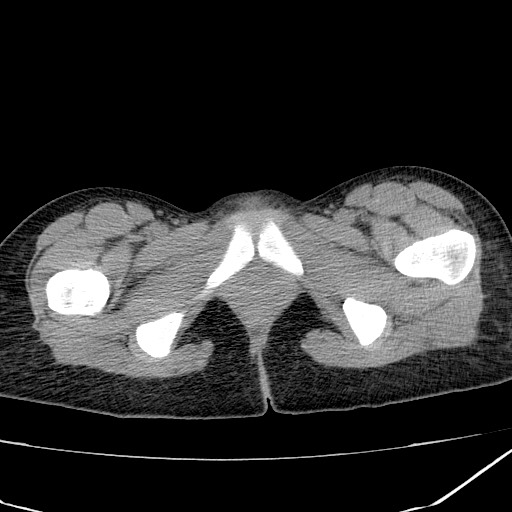 Acute bilateral pyelonephritis (Radiopaedia 74153-84969 Axial non-contrast 53).jpg