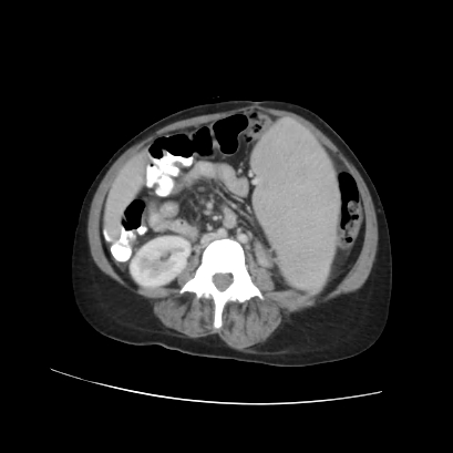 Acute calculous cholecystitis in patient with osteopetrosis (Radiopaedia 77871-90159 Axial C+ portal venous phase 50).jpg