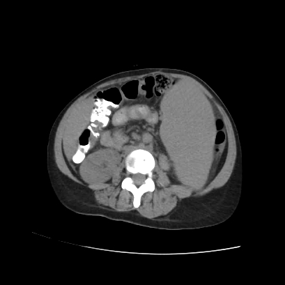 File:Acute calculous cholecystitis in patient with osteopetrosis (Radiopaedia 77871-90159 Axial non-contrast 48).jpg