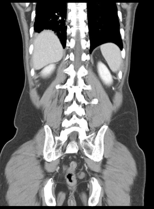 Acute cholecystitis (Radiopaedia 29814-30327 Coronal C+ portal venous phase 41).jpg