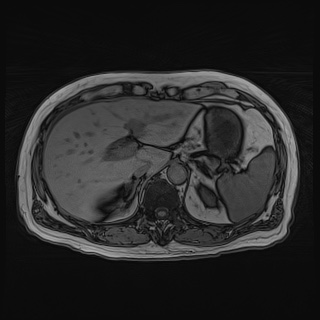 File:Acute cholecystitis (Radiopaedia 72392-82923 Axial T1 out-of-phase 40).jpg