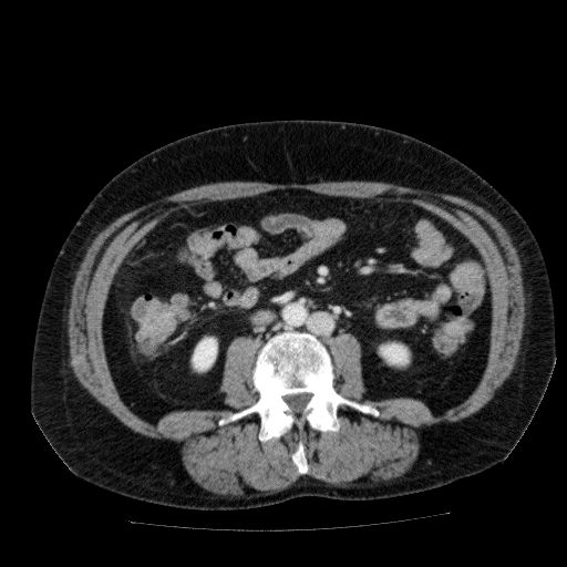 File:Acute cholecystitis and incidental left sided IVC (Radiopaedia 49352-54459 Axial C+ portal venous phase 83).jpg