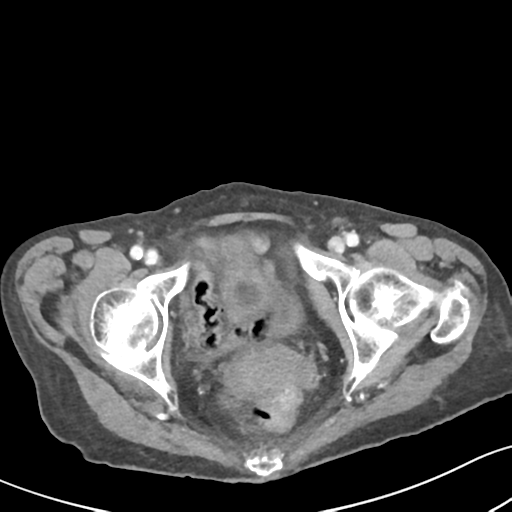 Acute cholecystitis with contained perforation (Radiopaedia 47328-51907 Axial C+ portal venous phase 69).png
