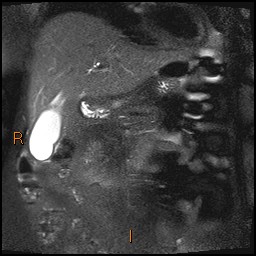 File:Acute cholecystitis with gallbladder neck calculus (Radiopaedia 42795-45971 Coronal T2 Half-fourier-acquired single-shot turbo spin echo (HASTE) 10).jpg