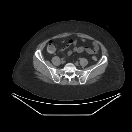File:Acute cholecystitis with tensile fundus sign (Radiopaedia 71394-81723 Axial non-contrast 83).jpg