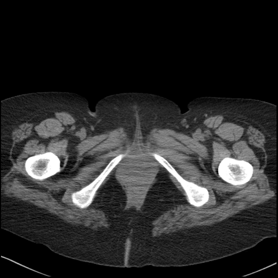 Acute colonic hemorrhage in ulcerative colitis (Radiopaedia 77415-89538 Axial non-contrast 145).jpg