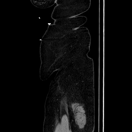 Acute diverticulitis - transverse colon (Radiopaedia 87063-103327 Sagittal C+ portal venous phase 208).jpg