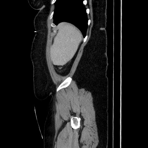 Acute diverticulitis - transverse colon (Radiopaedia 87063-103327 Sagittal C+ portal venous phase 57).jpg