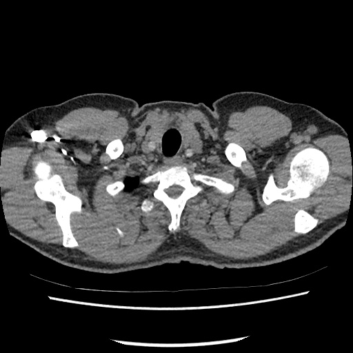 Acute epicardial fat necrosis (Radiopaedia 42327-45440 Axial C+ CTPA 11).jpg