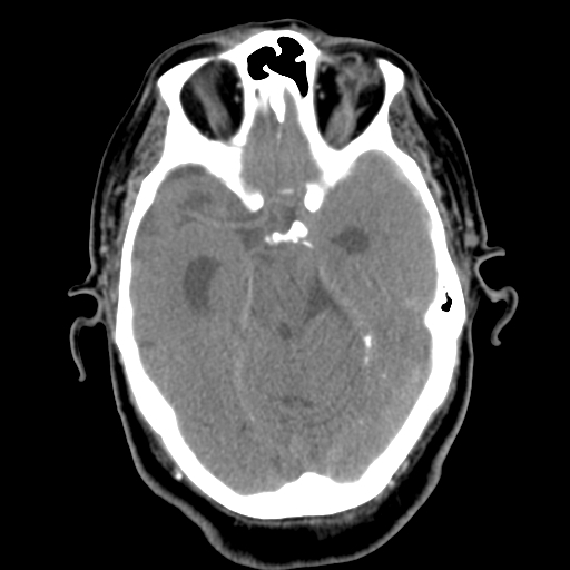 Acute hemorrhagic stroke (Radiopaedia 17507-17223 Axial non-contrast 19).jpg