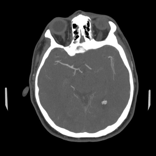 File:Acute internal carotid artery dissection (Radiopaedia 53541-59630 D 35).jpg