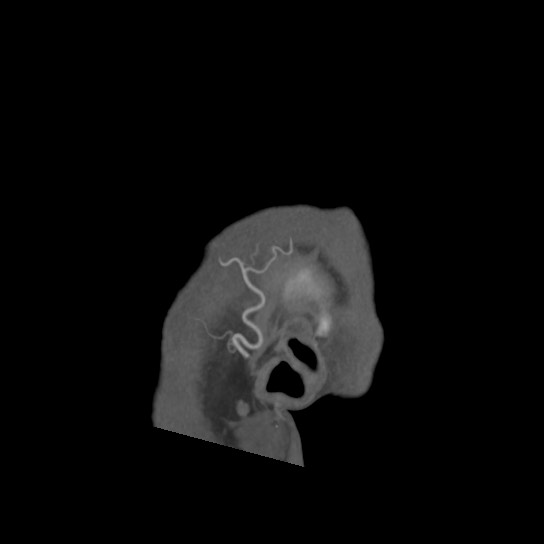 Acute internal carotid artery dissection (Radiopaedia 53541-59630 Sagittal C+ arterial phase 3).jpg