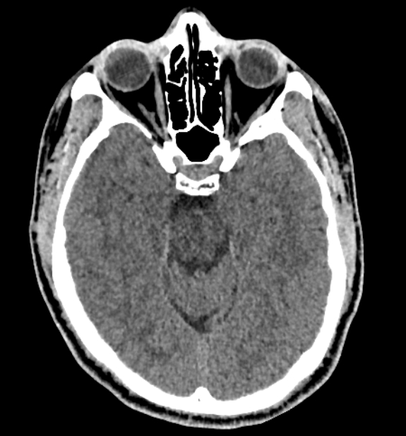 Acute ischemic stroke - posterior circulation territory (Radiopaedia 77670-89881 non-contrast 32).jpg