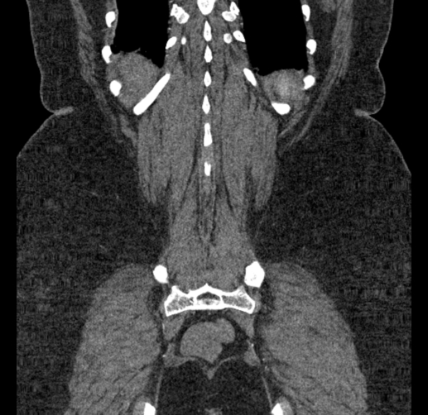 Acute mesenteric ischemia (Radiopaedia 80029-93316 Coronal C+ arterial phase 124).jpg