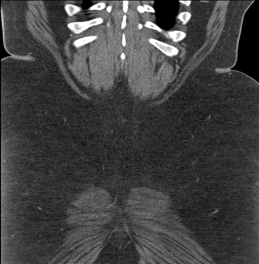Acute mesenteric venous ischemia (Radiopaedia 46041-50383 Coronal C+ portal venous phase 91).jpg