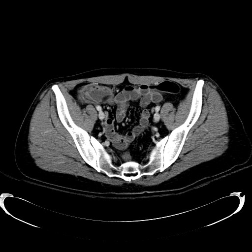 Acute myocardial infarction in CT (Radiopaedia 39947-42415 Axial C+ portal venous phase 105).jpg