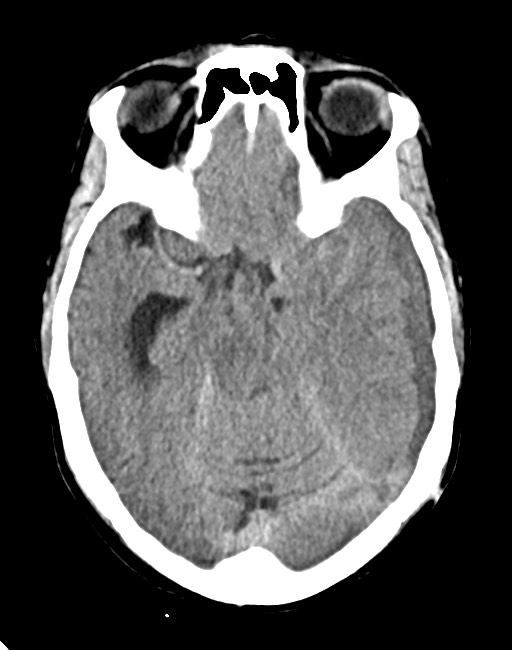 Acute on chronic subdural hematoma (Radiopaedia 74814-85823 Axial non-contrast 39).jpg