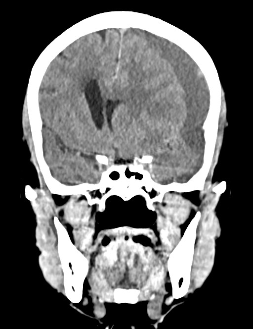 Acute on chronic subdural hematoma (Radiopaedia 74814-85823 Coronal non-contrast 27).jpg