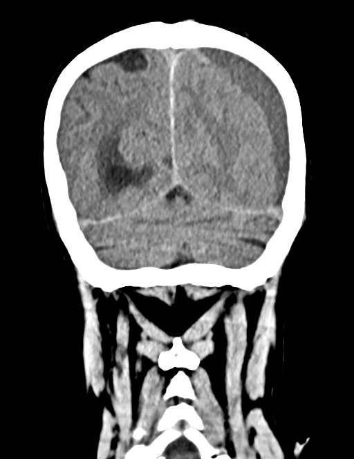Acute on chronic subdural hematoma (Radiopaedia 74814-85823 Coronal non-contrast 52).jpg