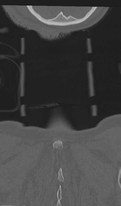 Acute on chronic subdural hematoma and thoracic vertebral injury in a multitrauma patient (Radiopaedia 31698-32619 Coronal bone window 76).jpg