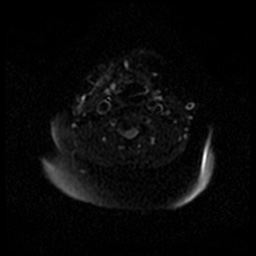 Acute otitis externa (Radiopaedia 57296-64236 Axial DWI 54).jpg
