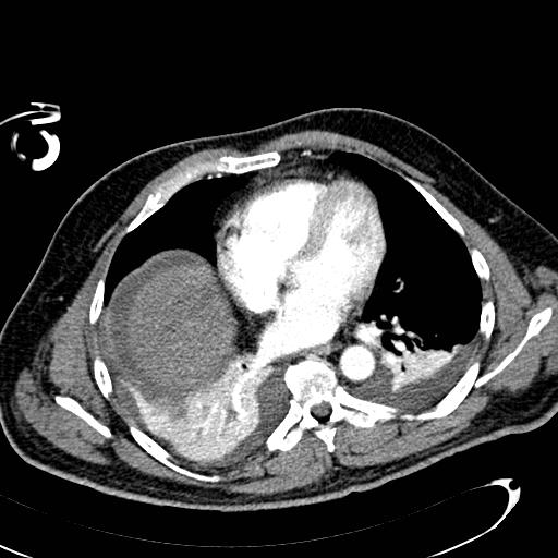 File:Acute pancreatic necrosis (Radiopaedia 13560-13486 Axial C+ portal venous phase 8).jpg